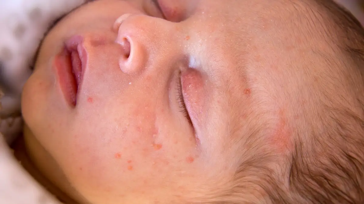 How to deal with acne in babies